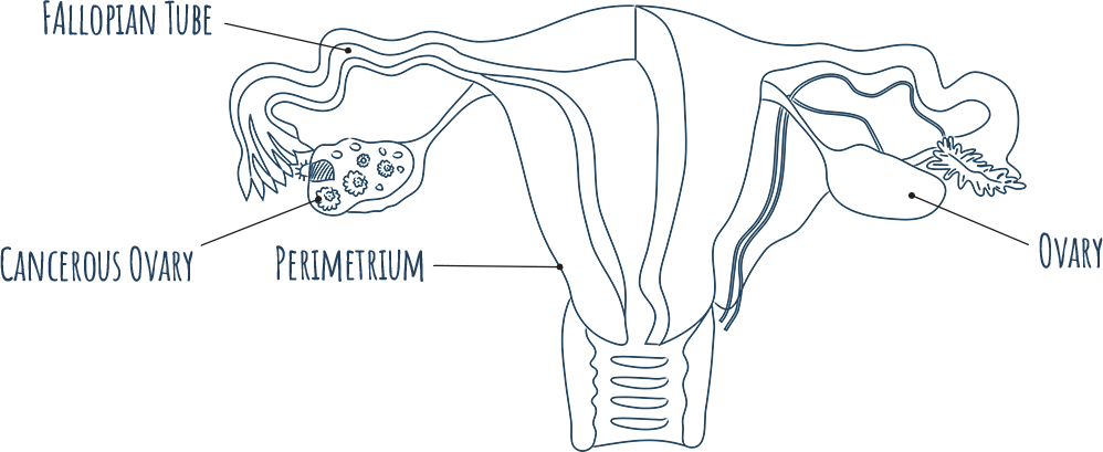 Diagram depicting a cancerous ovary